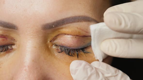 Lubrication Wounds After Blepharoplasty Eyelids