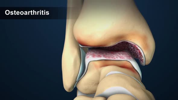 Osteoarthritis is the most common form of arthritis