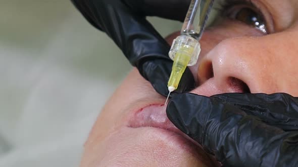 Senior Woman Gets Injection of Hyaluronic Acid in Her Lips