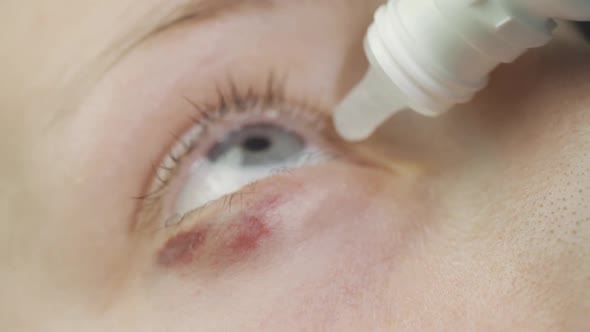 Doctor Helps the Patient and Gives the Eye Drops