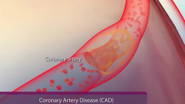 Plaque formation in the cardiovascular tract