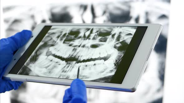 The Dentist Uses a Tablet with an Image of the X-ray of the Jaw. Bite Diagnosis, Braces System