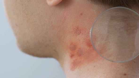 Dermatologist Examining Neck Rashes With Magnifying Glass, Allergy Reaction