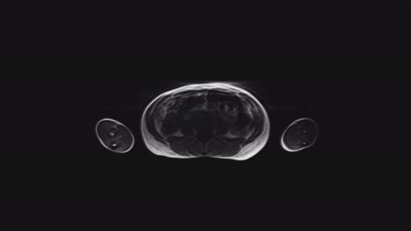 Voluminous MRI of the Female Pelvic Organs, Abdominal Cavity, Gastrointestinal Tract and Bladder