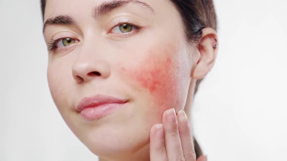 Close-up face of a young beautiful woman touching the inflammation rosacea on her cheek