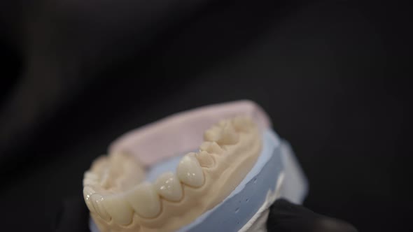 Installation of Veneers on the Jaw