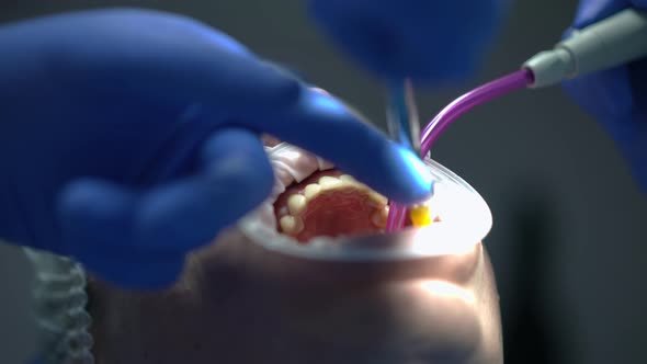 Closeup Patient Mouth with Retractor and Dentist Injecting Anesthesia As Assistant Removing Saliva