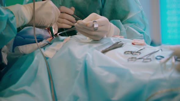 Surgical procedure. Hands in gloves performing an operation on a patient using surgical tools. 