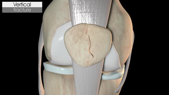 Patella Fracture   Vertical