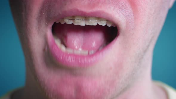 Close Up Mouth of Angry Man Smile with Dental Braces Close Up