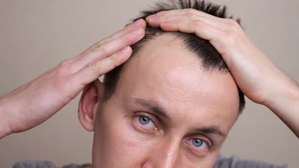 Young Man Examines His Bald Spots in the Mirror