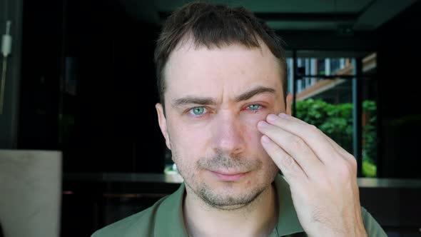 Sad Man Touch His Severe Bloodshot Red Blood Eye Affected By Conjunctivitis