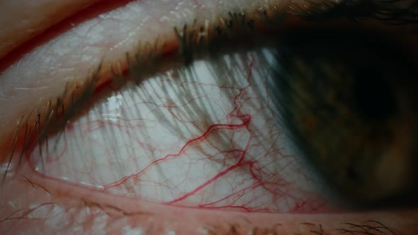 Conjunctivitis Red Eye