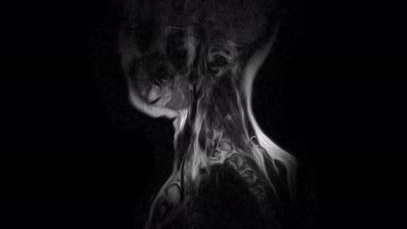 MRI of the Cervical Spine, Detection of Protrusions and Hernias