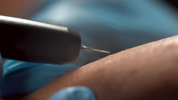 Process of Permanent Unwanted Hair Removal Using an Electroepilation Device and Tweezers