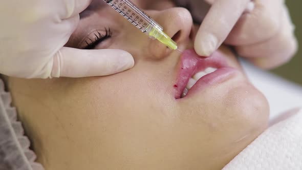 Close Up of Beautician Expert's Hands Injecting in Female Lips