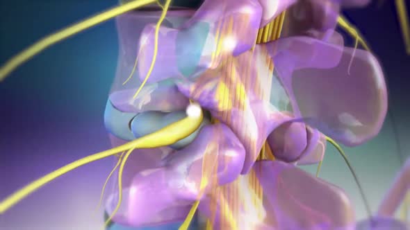 Medical Animation of Nerve compression syndrome