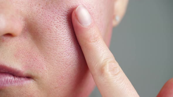 Skin Texture with Enlarged Pores