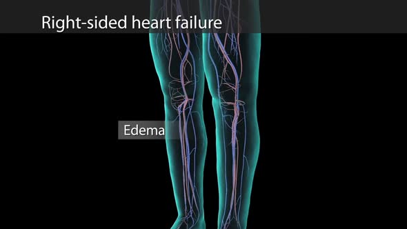 Edema formation in the leg due to right sided heart failure