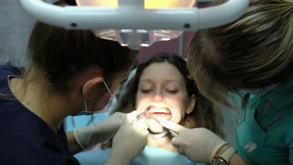 Dentist and the Assistant Wash the Special Gel From the Teeth Before Installing the Bracket System