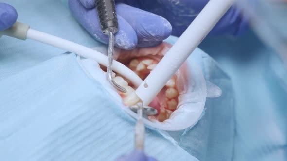 Drilling teeth and sucking saliva with ejector. Young woman at dental clinic.