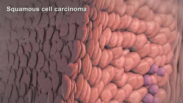 Cancer cells under the microscope