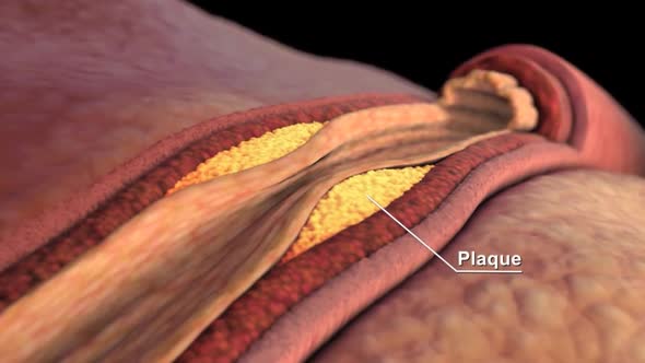 Plaques accumulating in the blood block the coronary arteries