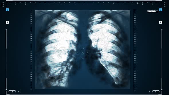 Xrays of the Human Lungs or Physical Therapy for Doctors with Lung Problems Such As Viruses Entering