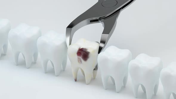 Animation of removing the sick tooth.