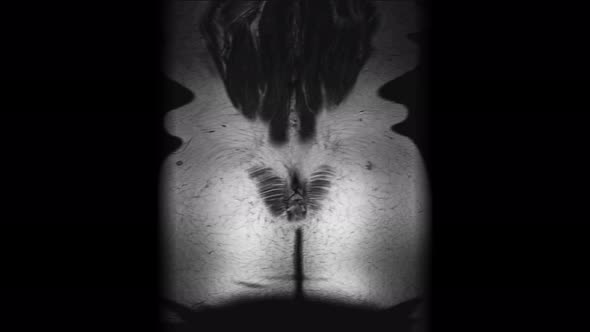Postoperative MRI of Female Organs for the Detection of Metastases