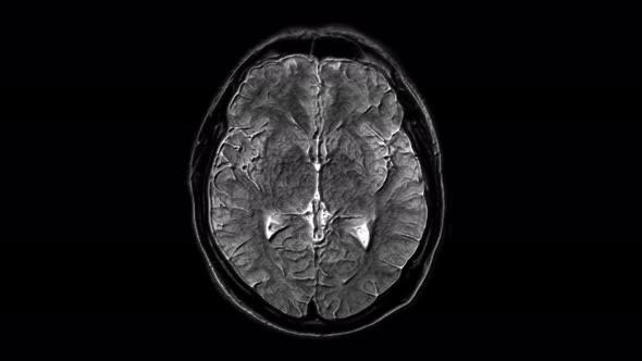 Voluminous MRI Scans of the Brain and Head To Detect Tumors. Diagnostic Medical Tool