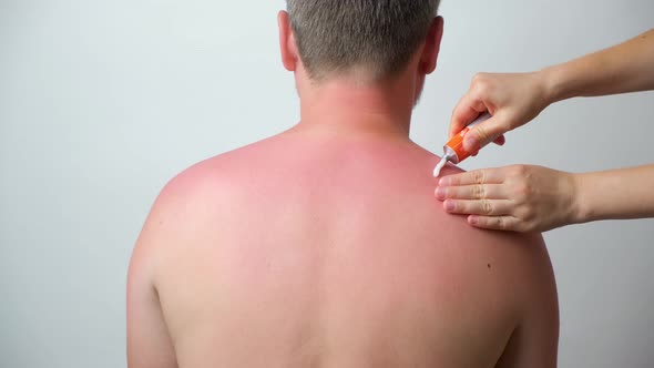 Applying Therapeutic Ointment to the Skin of a Person with a Sunburn Closeup