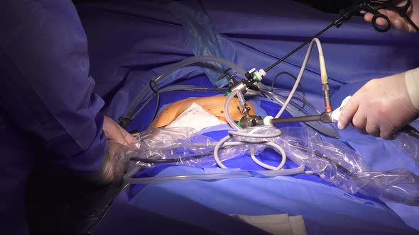 Laparoscopic Surgery