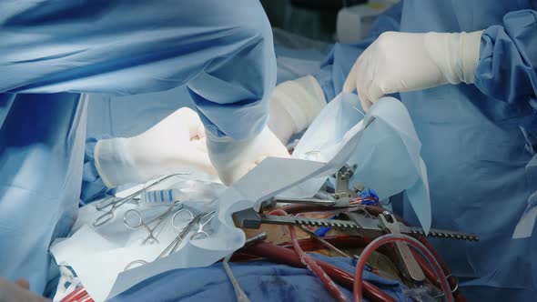 Surgeons working during open heart surgery, close up on hands and instruments.