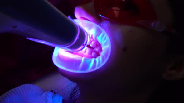 Closeup View of Young Woman Getting UV Whitening at the Dentist's Office By an Ultra Violet Machine