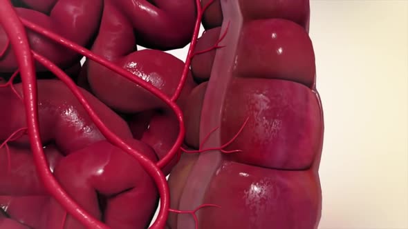 3D Medical animation of colon cancer. Tumor growth