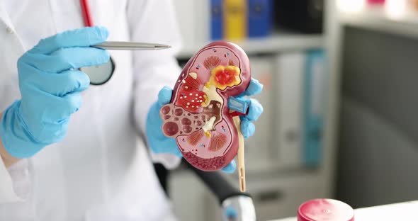 Educational Model of Human Body of Kidney in Hands of Doctor