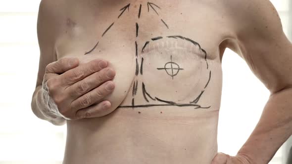 Preparing for Breast Reconstruction for a Woman Undergoing Mastectomy