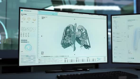 Human Lung Organ Cancer Disease Analysis By Medical Ct Scan At A Laboratory alt