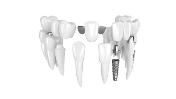 Toothing with different types of teeth rebuilding