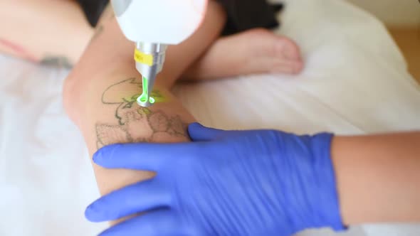 the Cosmetologist Removes the Tattoo on the Leg of a Young Pretty Girl with a Laser