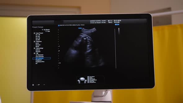 Image of Fetus on Screen of Ultrasound Machine