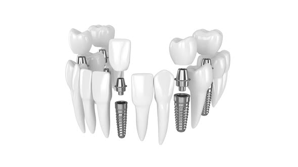 Toothing with dental implants over white background