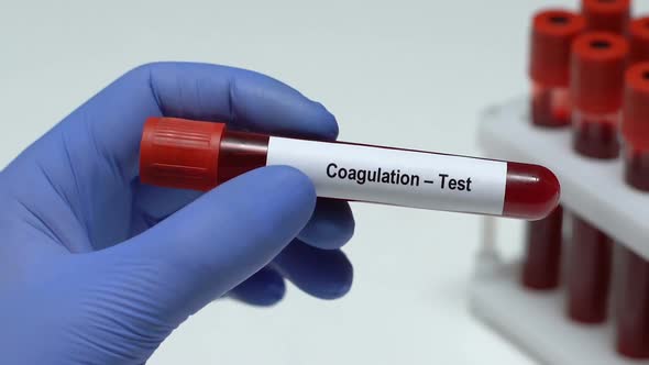 Coagulation-Test, Doctor Holding Blood Sample in Tube Close-Up, Health Check-Up