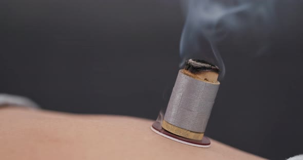 Chinese medicine moxibustion therapy 