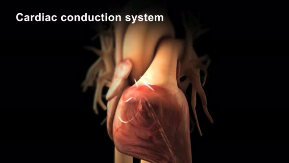 Catheter ablation is the treatment of arrhythmia with radio waves.