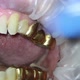 dentistry.removal of the gold bridge of the upper jaw using a hook - VideoHive Item for Sale