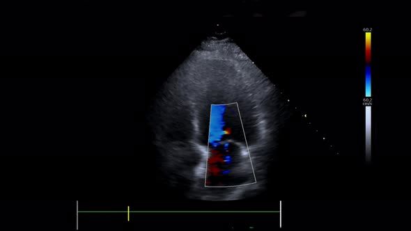 A Monitor of the Ultrasound Machine with Echocardiography View