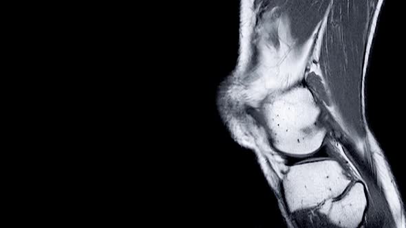 Magnetic Resonance Imaging (MRI) of Right Knee