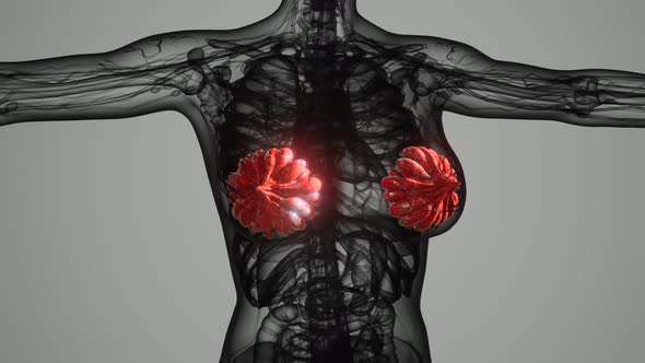 Medical Scan of Woman Breast Cancer